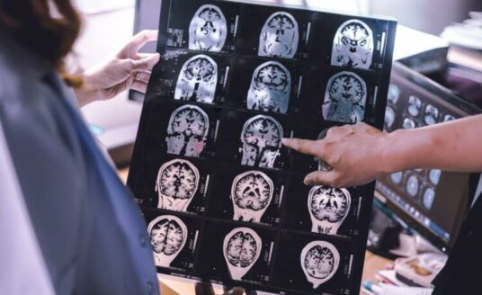Two people review a brain scan of a person with LATE dementia