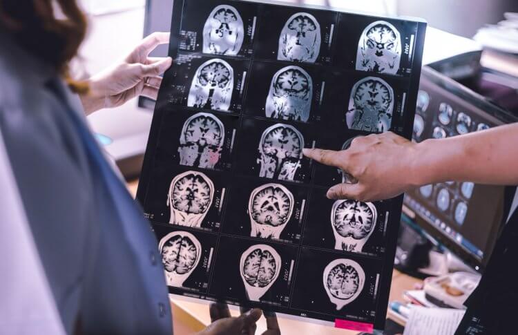 Two people review a brain scan of a person with LATE dementia