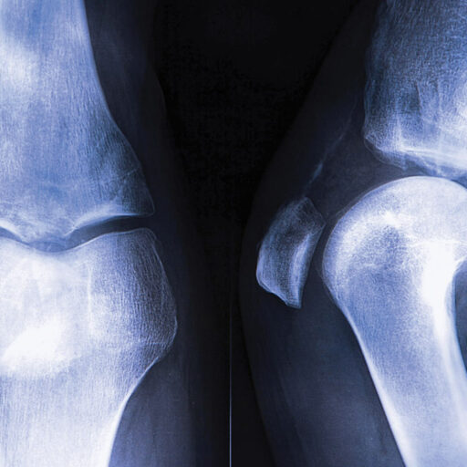 X-ray of bones used to educate about preventing osteoporosis
