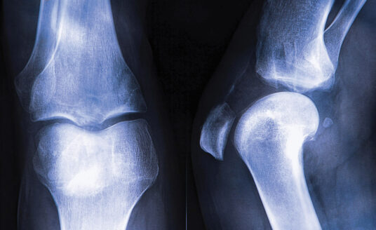X-ray of bones used to educate about preventing osteoporosis