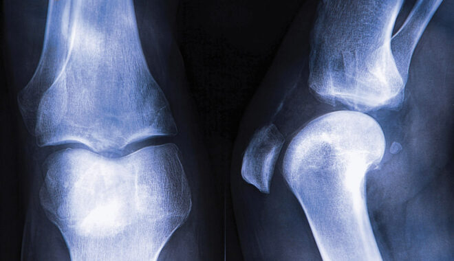 X-ray of bones used to educate about preventing osteoporosis