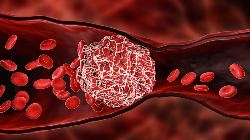Illustration of blood clots forming in a vein.